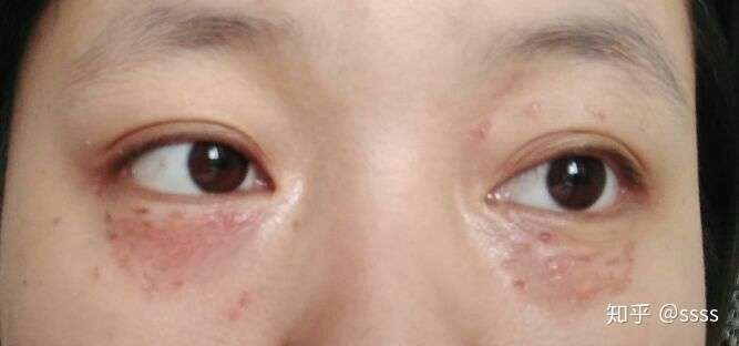 眼睛下面长的扁平疣怎么去掉