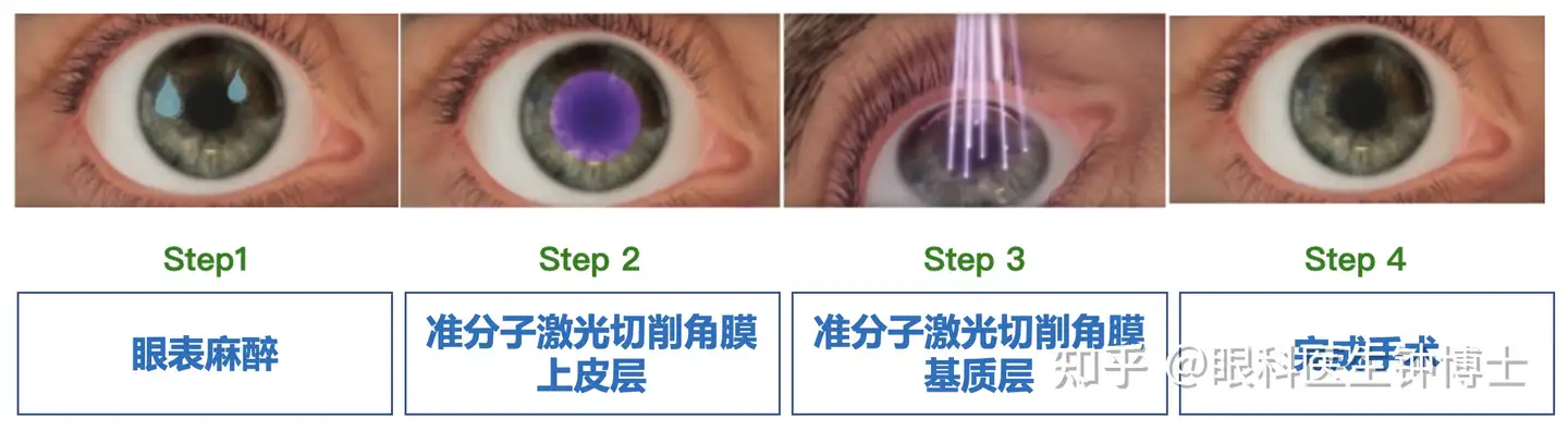 眼手術学4 角膜・結膜・屈折矯正-