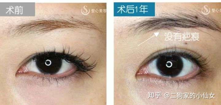 真实日记 年轻5岁的提眉术体验 眉下切 知乎