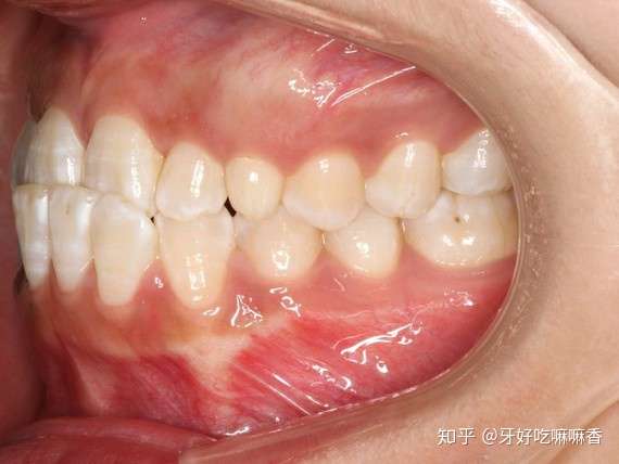 牙齿变白小心是脱矿