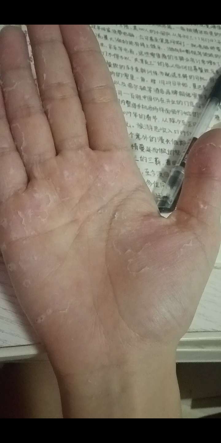 手为什么脱皮?