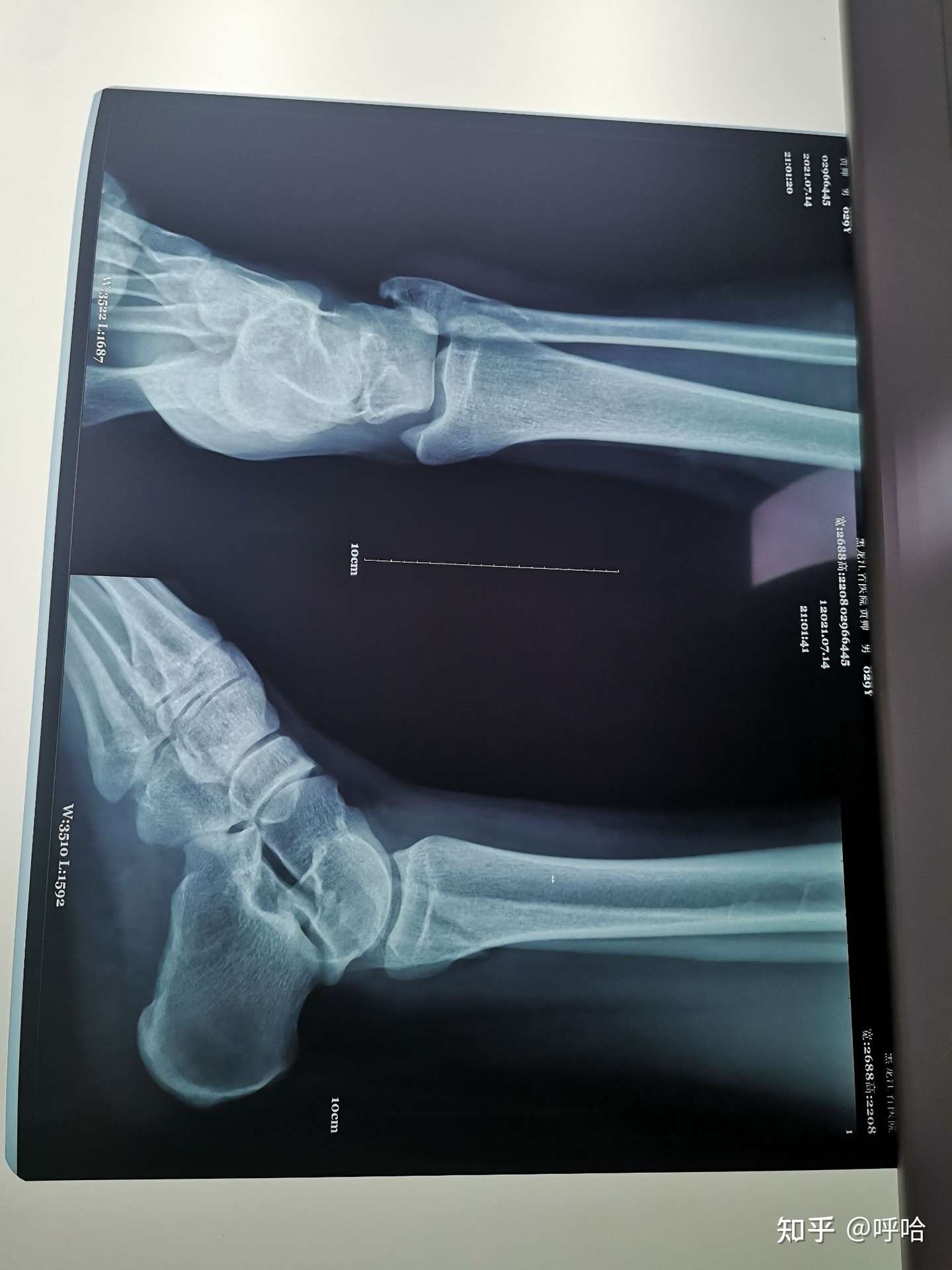 腓骨骨折三伏天 知乎