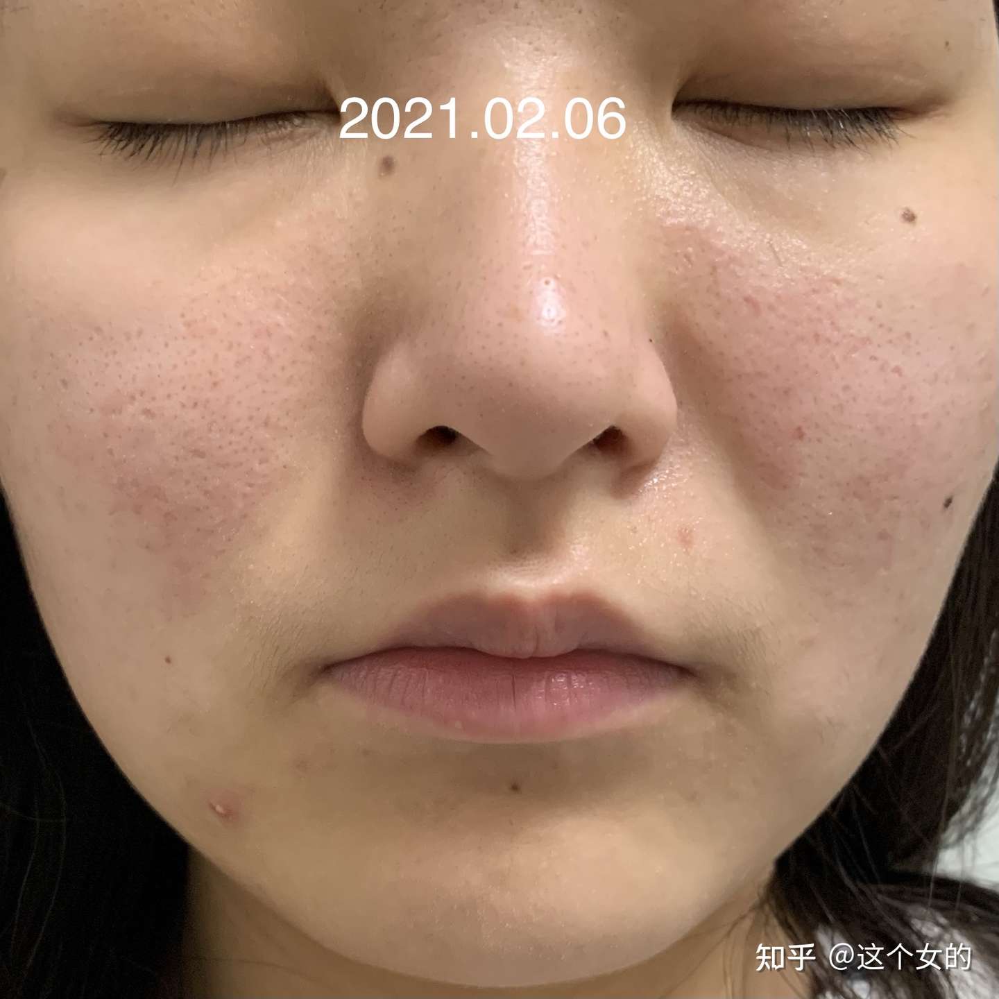 异维a酸停药半年多后复发 真正的勇士就是再吃一次 持续更新 知乎