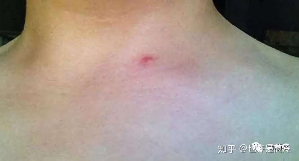 警惕 身上长出这2种痣 是肝脏出了问题 知乎
