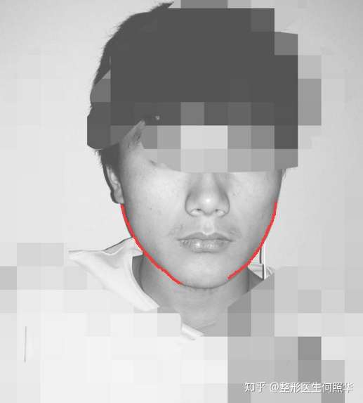 会很丑吗 感觉自己的咀嚼肌很大?