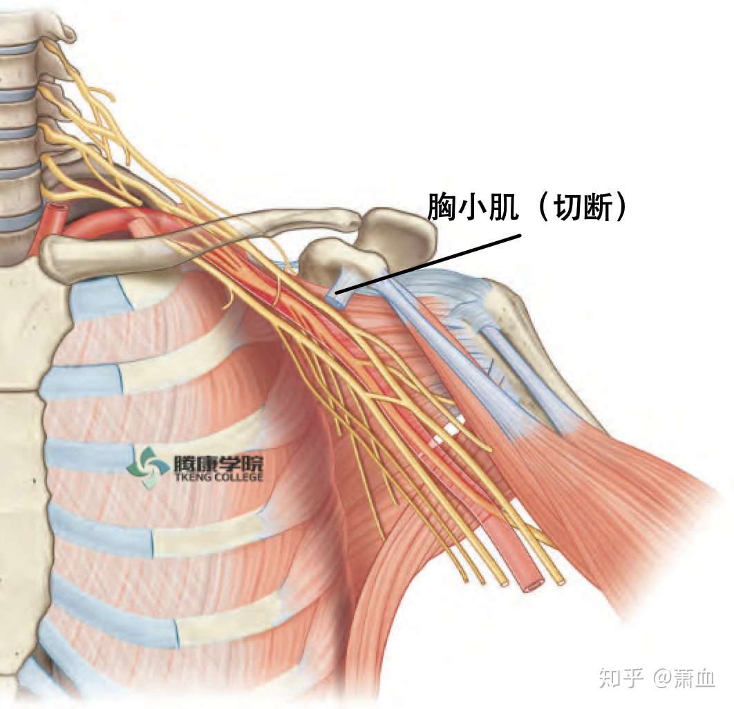 胸廓出口综合征 知乎