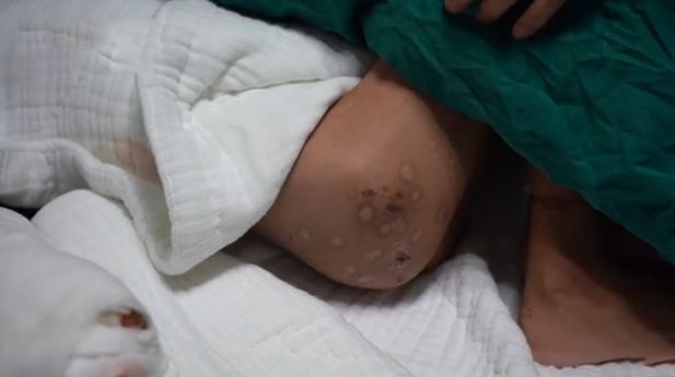 男童遭亲父烟头烫伤双手