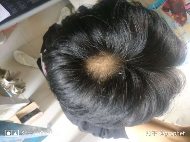 我才20岁就快秃顶了怎么办?