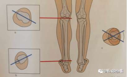 异常体态之胫骨扭转
