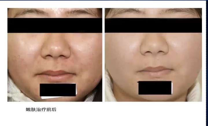 医美的效果强大到真的会上瘾(图20) 医美的效果强大到真的会上瘾(图20)