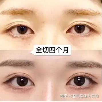 做双眼皮时上睑松弛和上睑下垂中的区别大家都知道吗