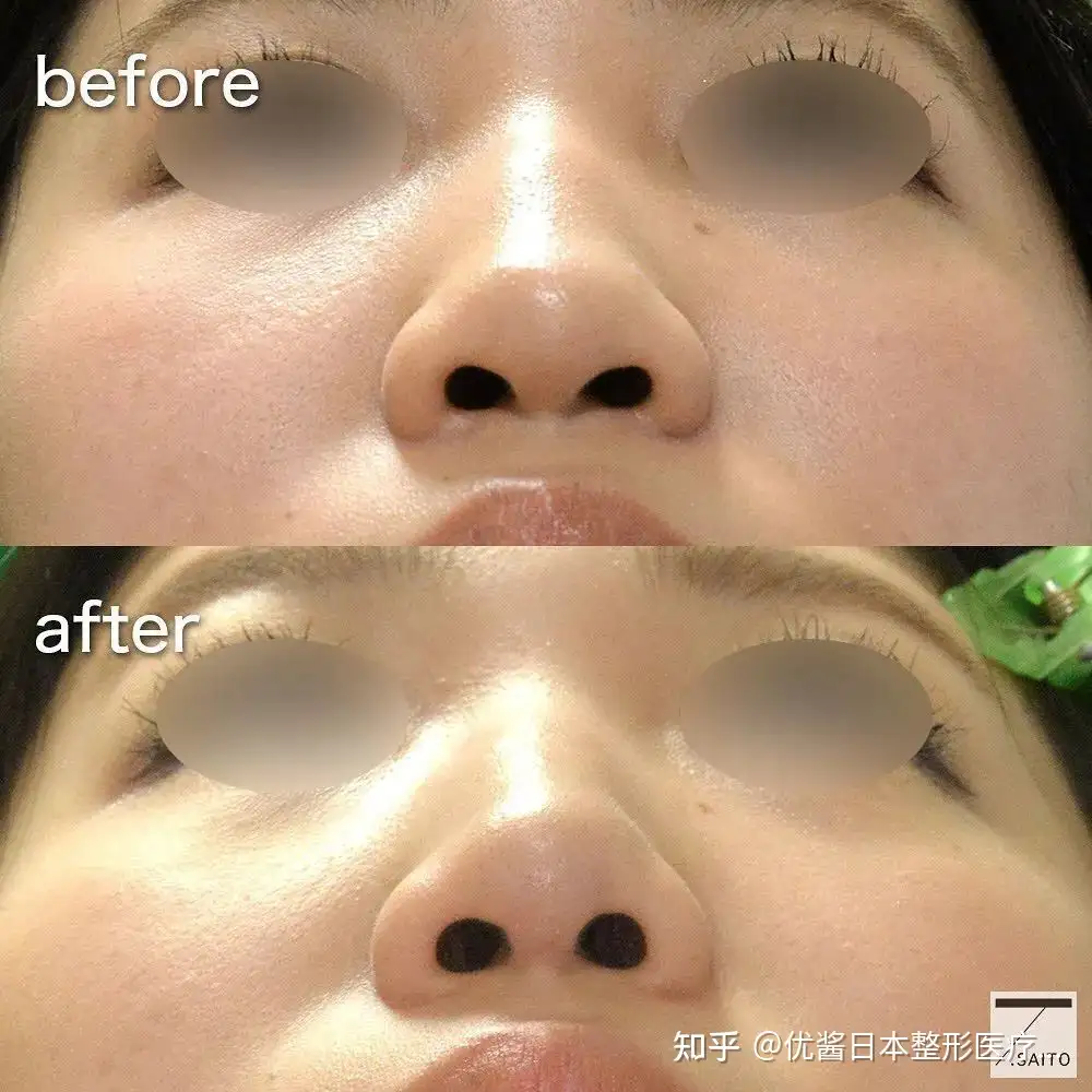大人も着やすいシンプルファッション 鼻形成術 美容外科手術手技 : Rhinoplasty Aesthetic = 健康/医学