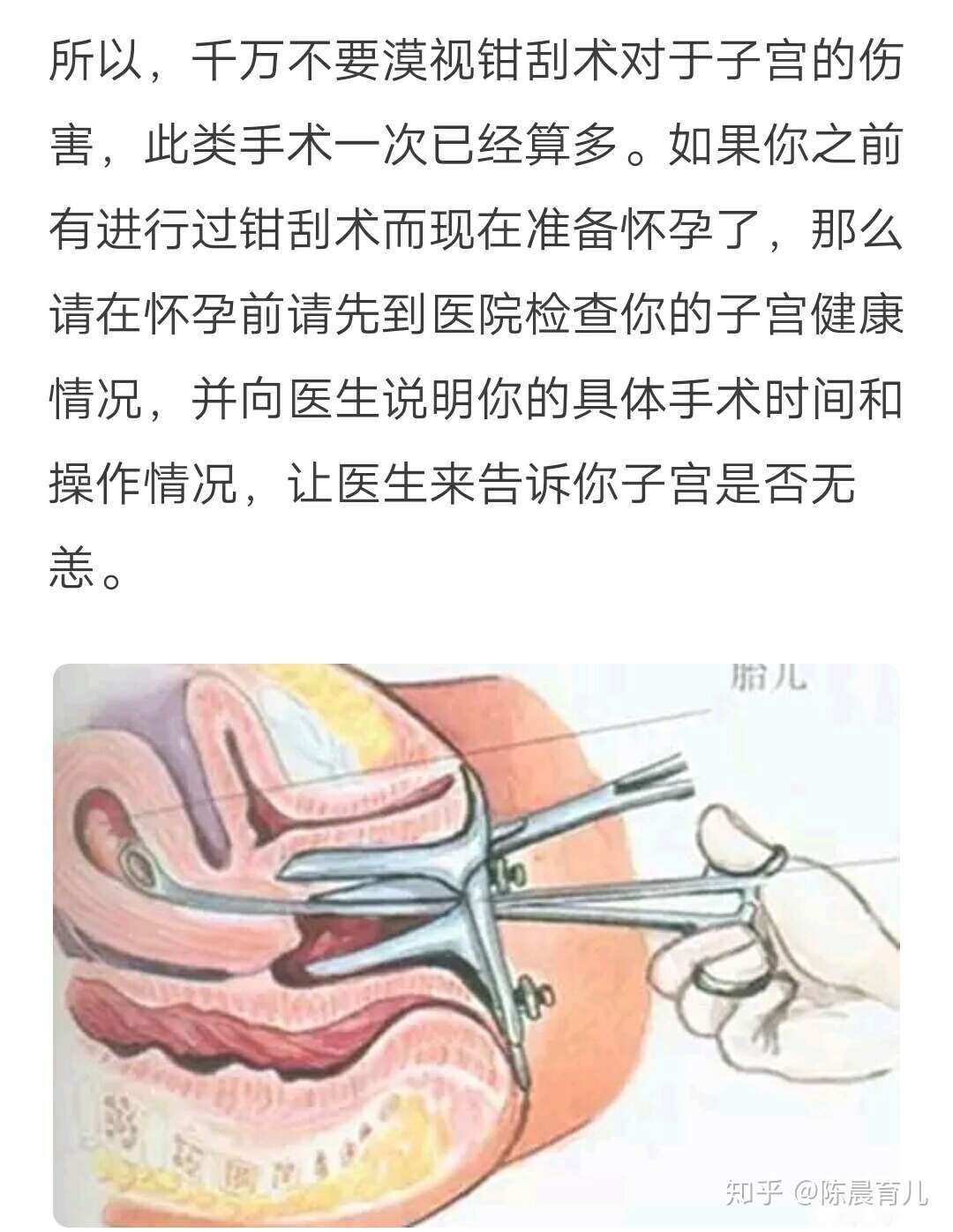 陈晨育儿 的想法: 凡是人为的终止正常妊娠的流产方式对女性… - 知乎