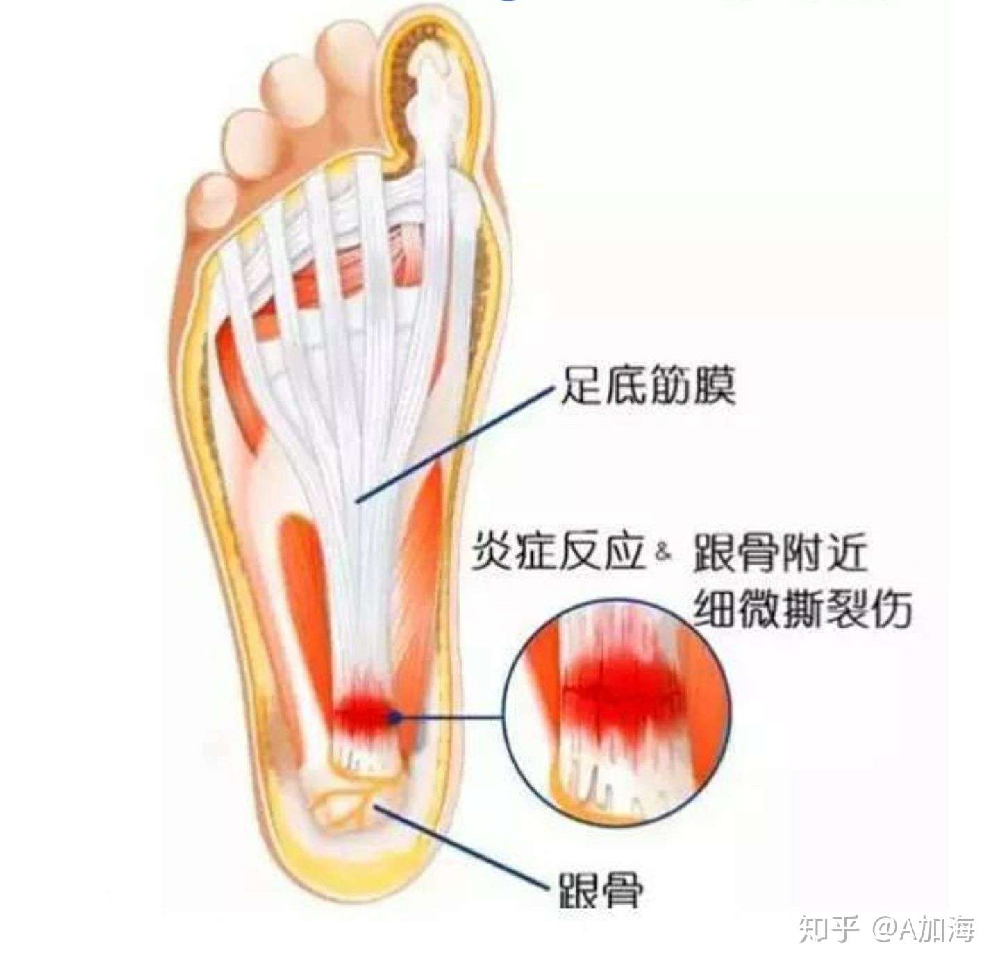 生活中的常见损伤 足底筋膜炎改善 知乎