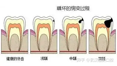 武漢綴美口腔:蛀牙不補究竟有多可怕?