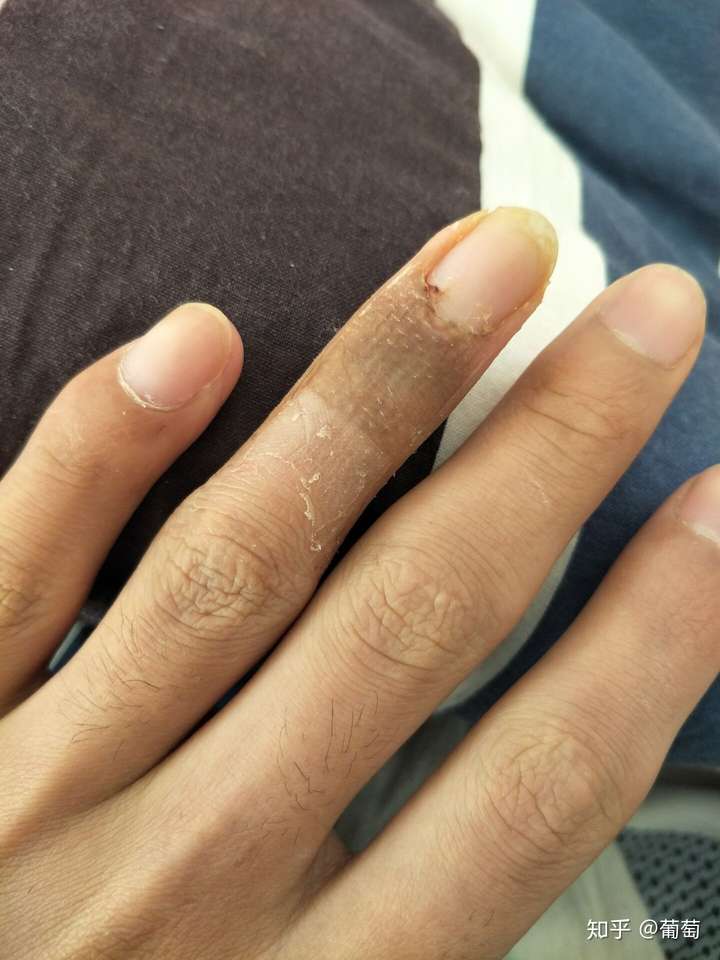 锤状指 - 知乎