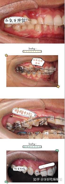牙齿开窗牵引过程图片图片