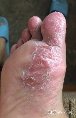 你所知道的最简单的治疗脚气的方法是什么