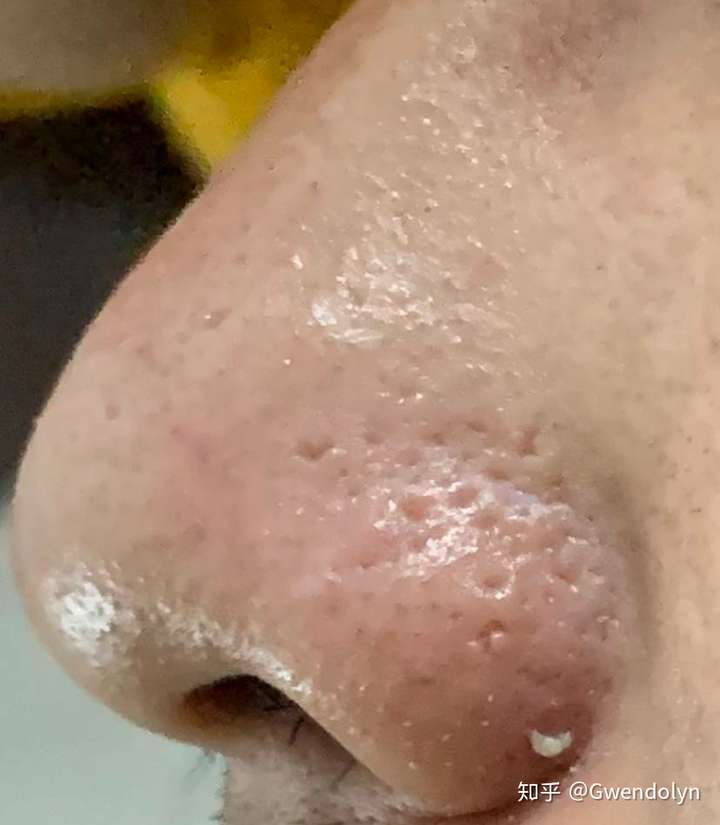 给你看看真正的" 大毛坑",你就会知道这种小毛孔是多么的幸运!