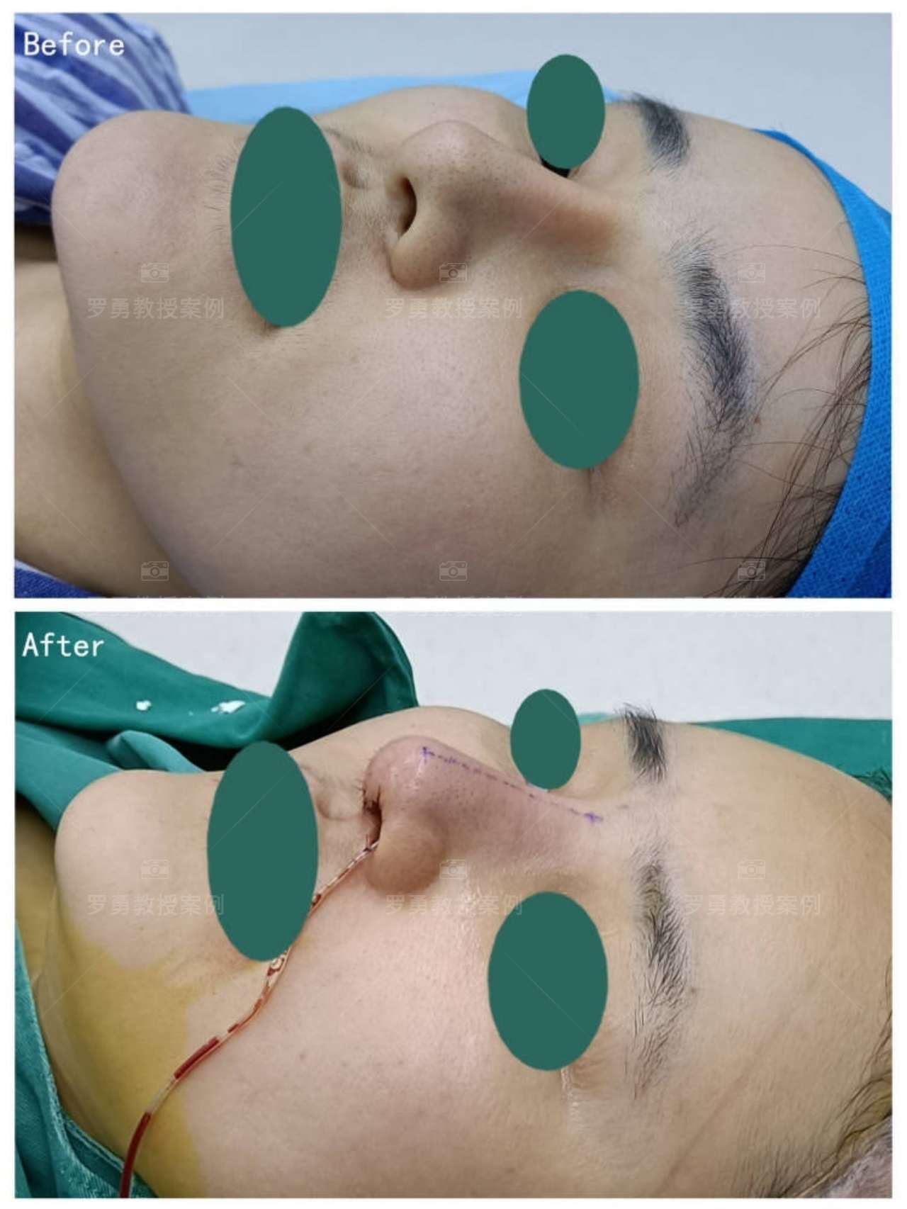 罗勇整形医生 的想法: 【鼻梁歪斜山根过高|鼻综合修复术后即刻