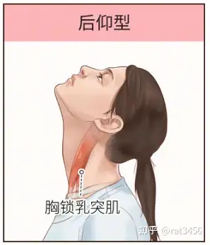 痉挛性斜颈几种形态