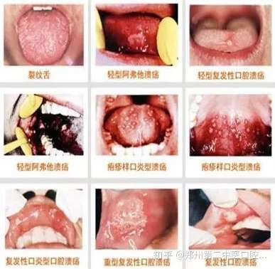 口腔癌早期的症状表现是什么 知乎