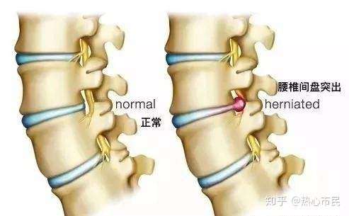 腰间盘突出患者注意 夏季做好这几点腰间盘突出远离你 知乎