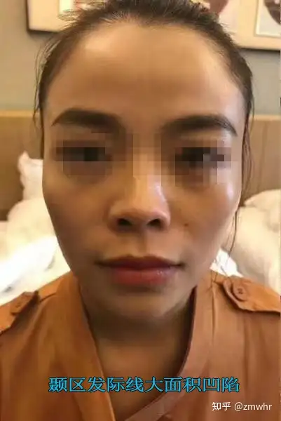 填充太阳凹后悔_太阳**凹陷填充花多少钱_填充太阳凹会不会显脸大