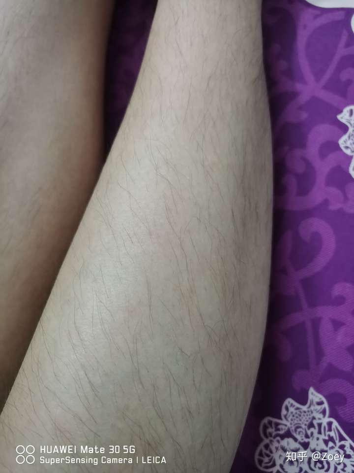 女生腿毛长正常吗?