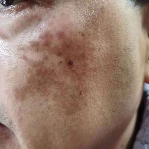 皮肤医生李志忠 的想法: 黧黑斑 | 黧黑斑是指颜面出现面积大小不… - 知乎