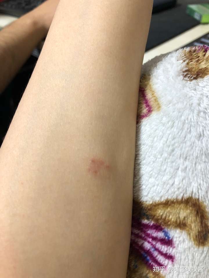 这是个什么虫子,像个飞蚂蚁 ,纯黑,叮一下,一波一波的灼烧痛感如潮.