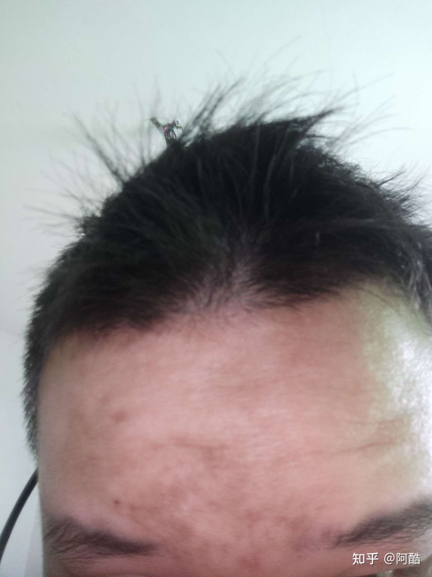 印堂发黑怎么办 是有什么病么 知乎