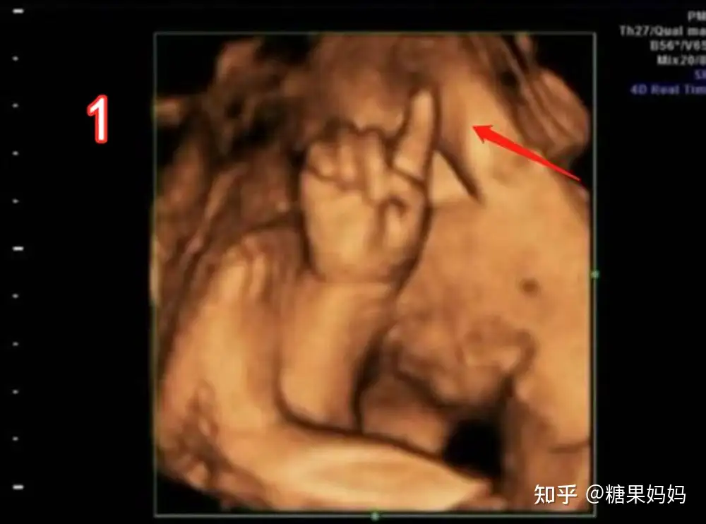 胎宝宝做四维彩超比划“数字”，能从1数到4，医生恭喜：好苗子- 知乎
