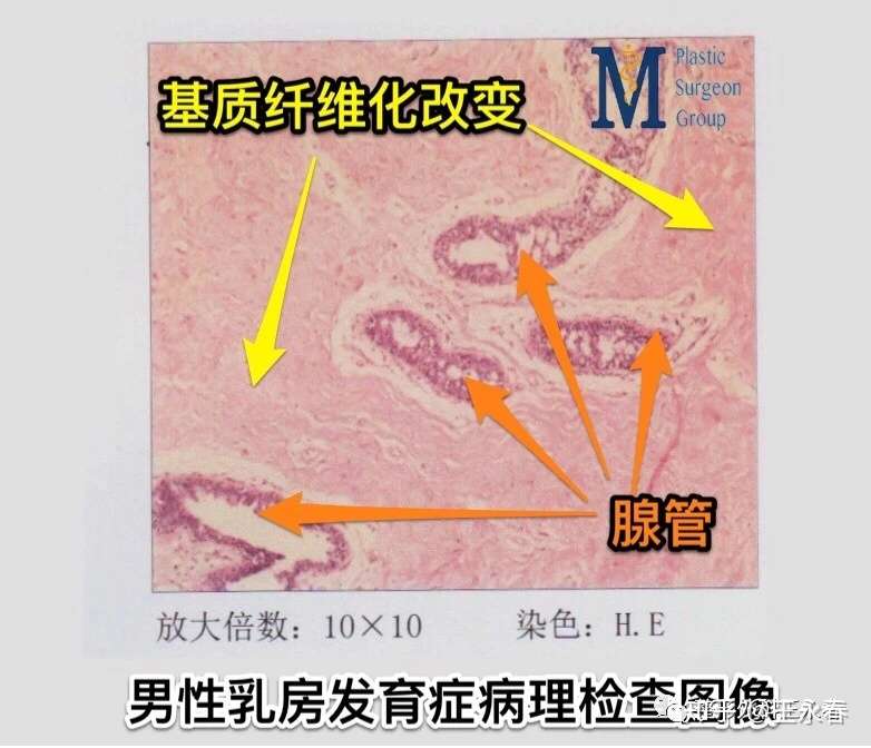 王永春 的想法: #男性乳房发育症# 研究显示,当异常发育… - 知乎
