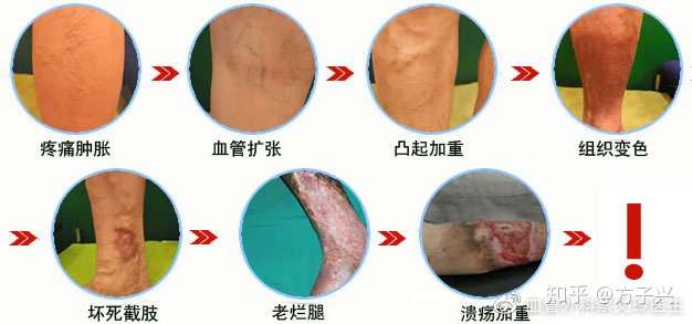 下肢慢性溃疡:治疗之路与最新动态探索