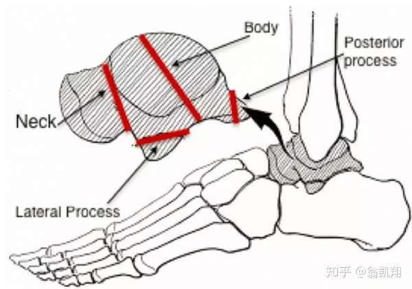 脚踝扭伤久未恢复如何才能恢复运动能力