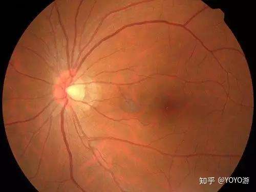 请问高度近视77玻璃体浑浊可以顺产吗