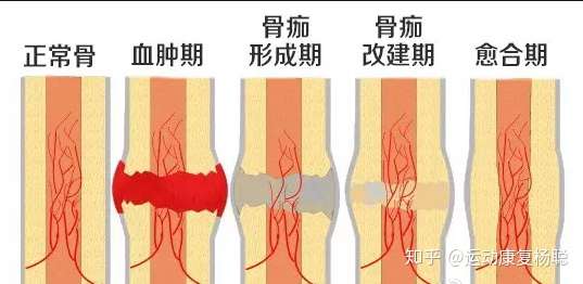 骨折运动康复生物力学原理
