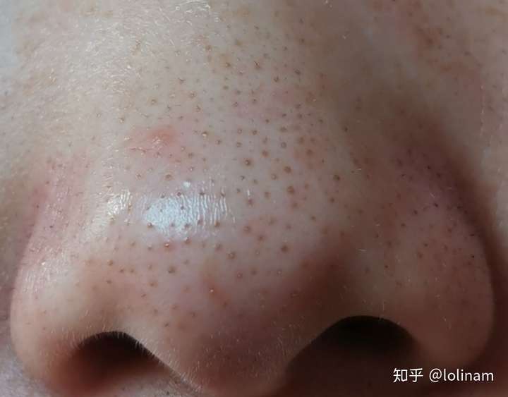 我这种是假性黑头?怎么去除呢?