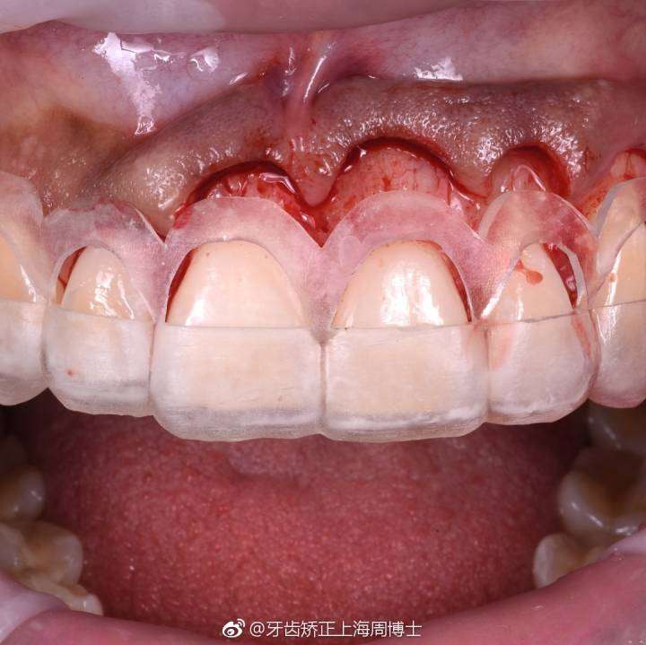 几种解决大笑露牙龈 露龈笑 问题的办法简述 知乎