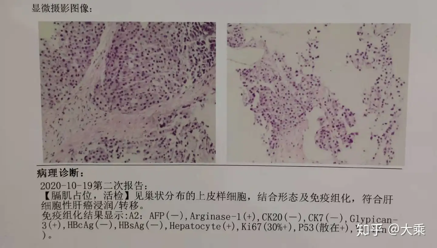 一文读懂肝细胞癌的免疫组化报告 知乎