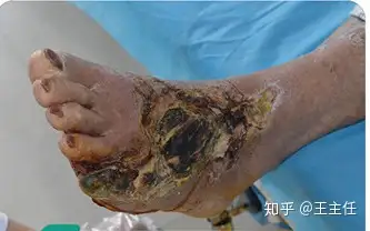 糖尿病足溃烂结痂发黑了是什么原因?
