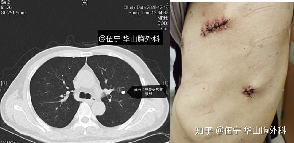 胸部ct的种种 辐射 增强ct 薄层 Pet Ct和怀孕风险 附病例左肺上叶微浸润腺癌行固有段切除 知乎