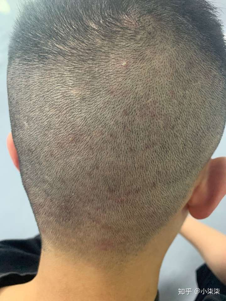 头皮上有很多红色连片的疙瘩 怎么办?