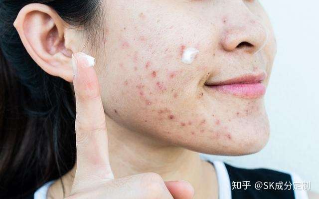 为什么痘痘总爱在同一个地方反复生长