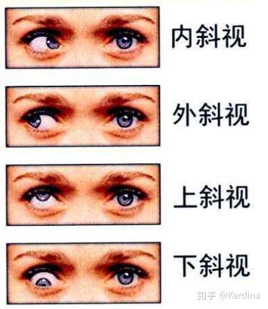 怎样预防斗鸡眼?