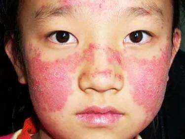 如果真的能够实现,能够解决红斑狼疮的问题,该多好!