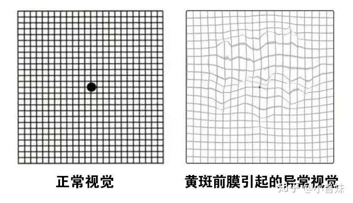 黄斑区测试图图片