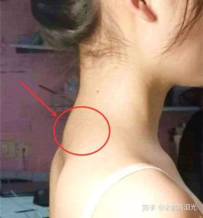 瘦下来对背厚富贵包的情况有改善吗?