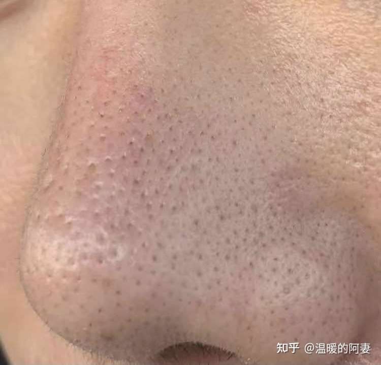 吃异维a酸为了控油 但鼻子上的毛孔怎么越来越大了 知乎